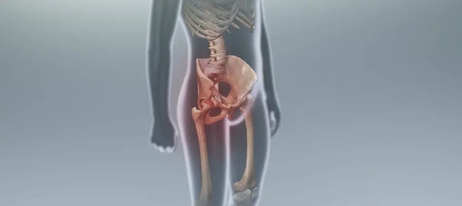 photo of hip arthritis