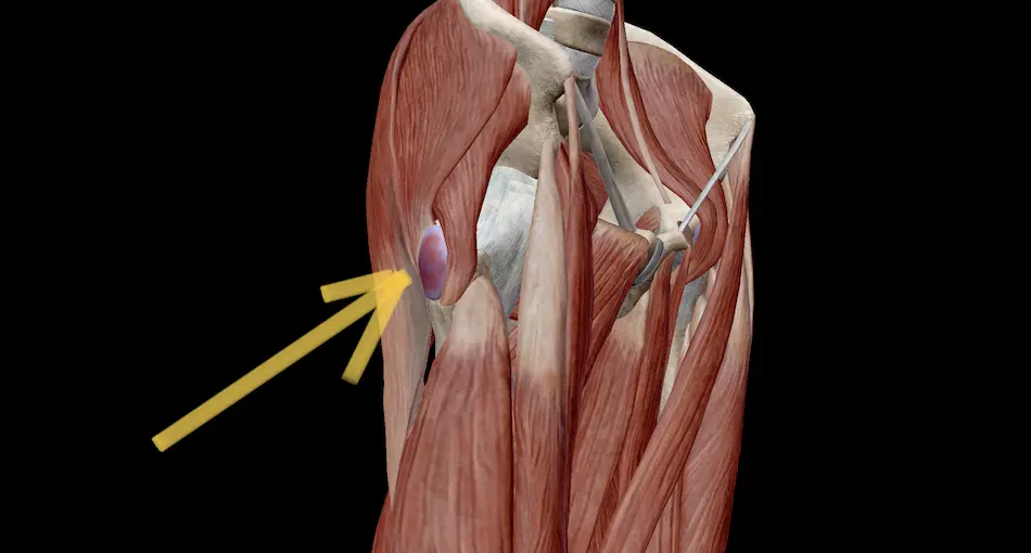 photo of hip bursitis
