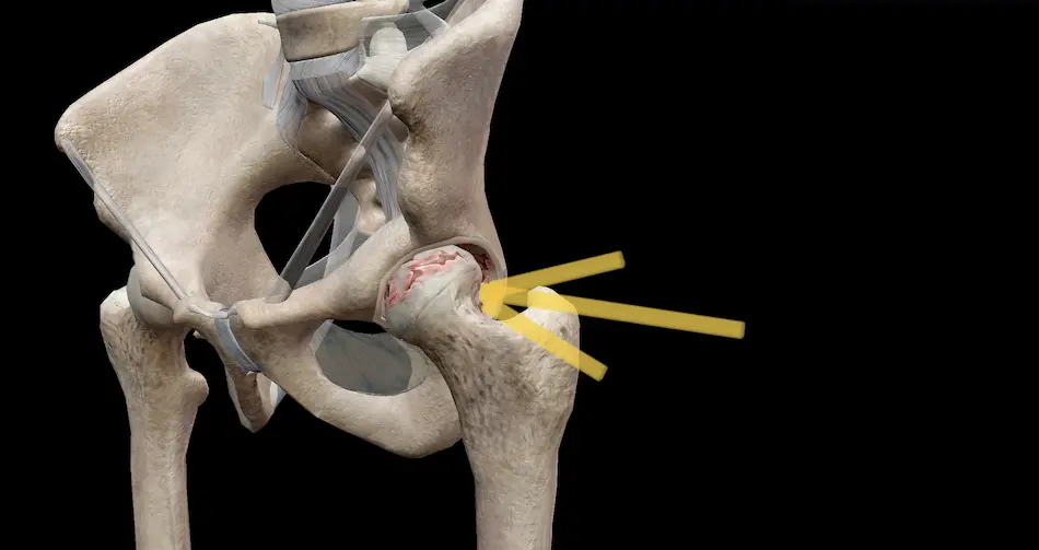 photo of hip osteoarthritis